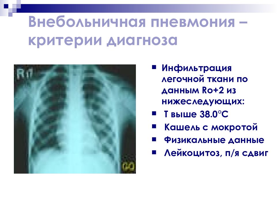 Двухсторонняя пневмония карта вызова