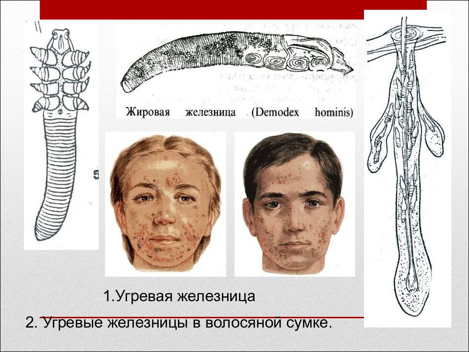 Демодекс Железница угревая. Железница угревая Demodex folliculorum. Железница угревая Demodex folliculorum жизненный цикл. Железница угревая строение.