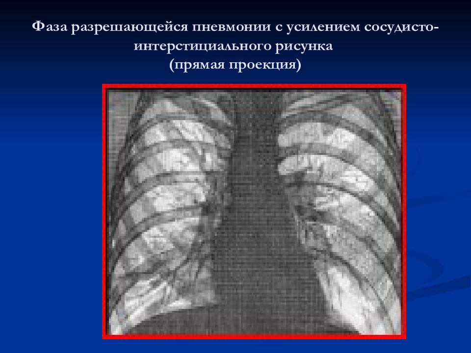 Усилен сосудистый рисунок легких что это