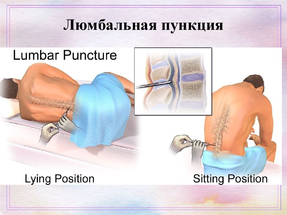 Люмбальная пункция презентация