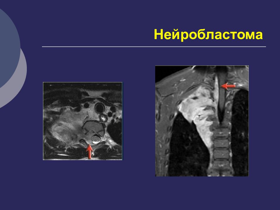 Нейробластомы у детей презентация