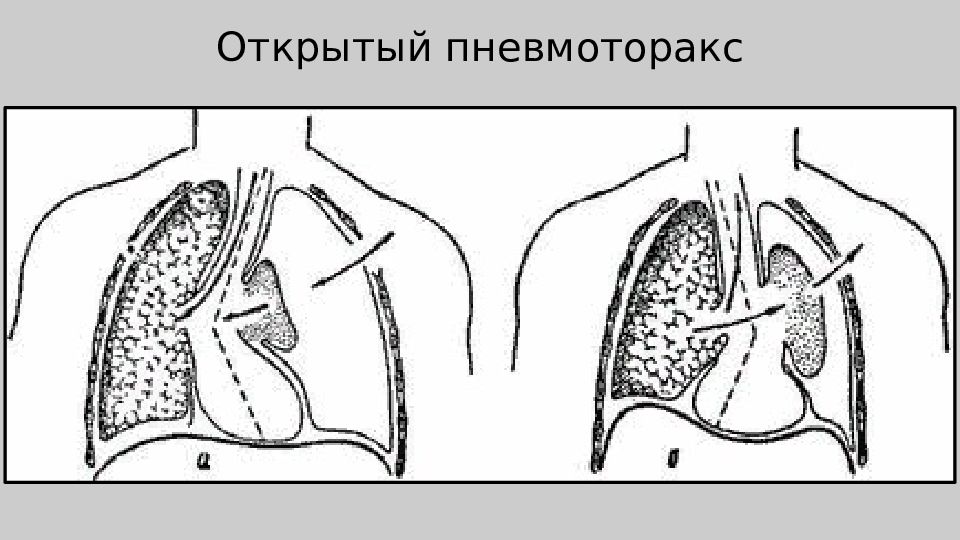 Открытый пневмоторакс. Травматический открытый пневмоторакс. Схема дыхания при пневмотораксе. Схема парадоксального дыхания. Левосторонний малый пневмоторакс.