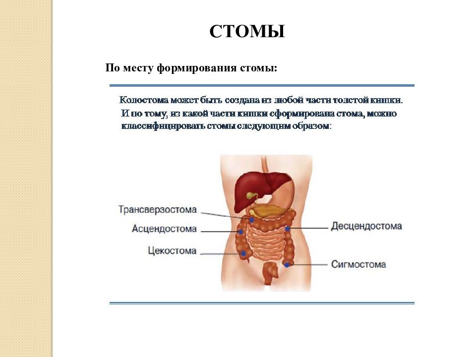 Виды стом схема