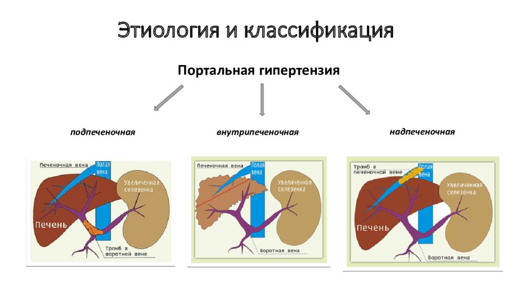 Портальная гипертензия. Синдром портальной гипертензии классификация. Формы портальной гипертензии. Подпеченочная портальная гипертензия. Портальная гипертензия вне печоночная форма.