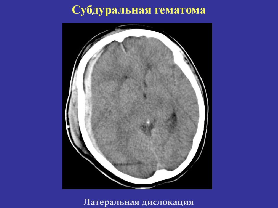 Субдуральная гематома. Острая субсубдуральной гематомы кт. Кт субдуральной гематомы. Субдуральная гематома межполушарной щели. Острая субдуральная гематома кт.