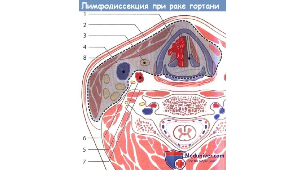 Минет Рак Горла