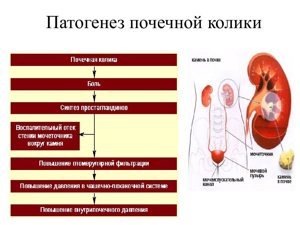 Кровь в почках у мужчин. Патогенез почечной колики. Почечная колика этиология. Патогенез боли при почечной колике. Механизм развития почечной колики.