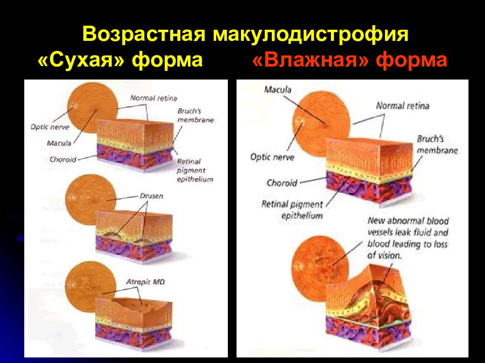 Возрастная макулярная дегенерация презентация