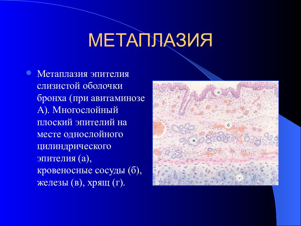 Реактивные изменения метаплазированных клеток