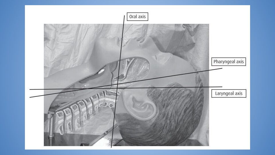 Трудные дыхательные пути в анестезиологической практике. Difficult Airway