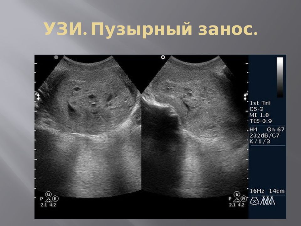 Пузырный занос презентация