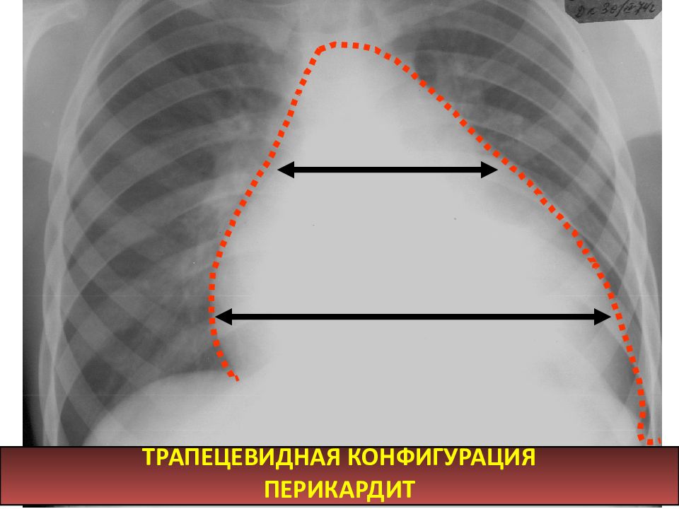 Трапециевидное сердце. Шаровидная конфигурация сердца. Трапециевидная конфигурация сердца. Трапециевидная конфигурация сердца рентген. Митральная конфигурация сердца рентген.