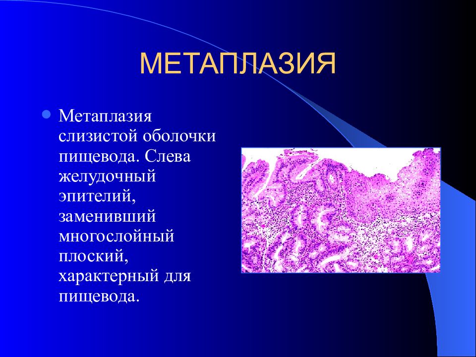 Реактивные изменения метаплазированных клеток