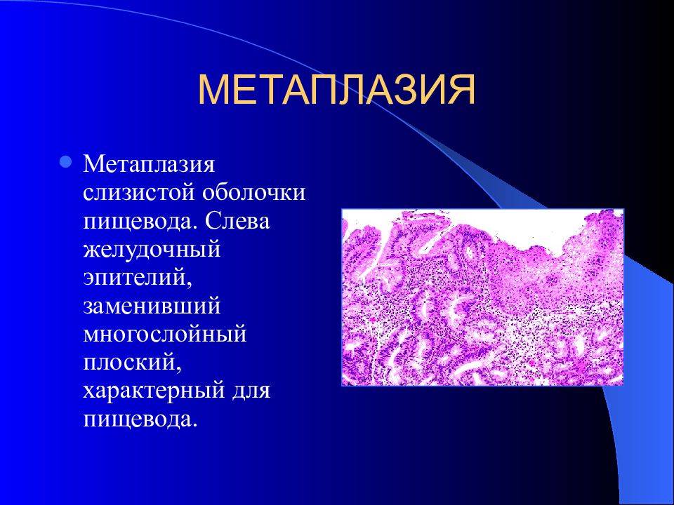 Метаплазия это. Метаплазия желудочного эпителия дисплазия. Метаплазия патанатомия. Кишечная метаплазия желудка патологическая анатомия. Метаплазия эпителия пищевода.