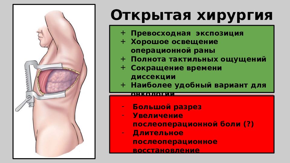 Торакальная хирургия презентация