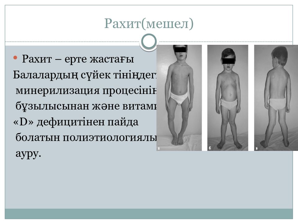 Рахит презентация казакша