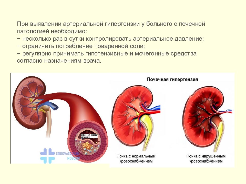 Влияние алкоголя на почки презентация