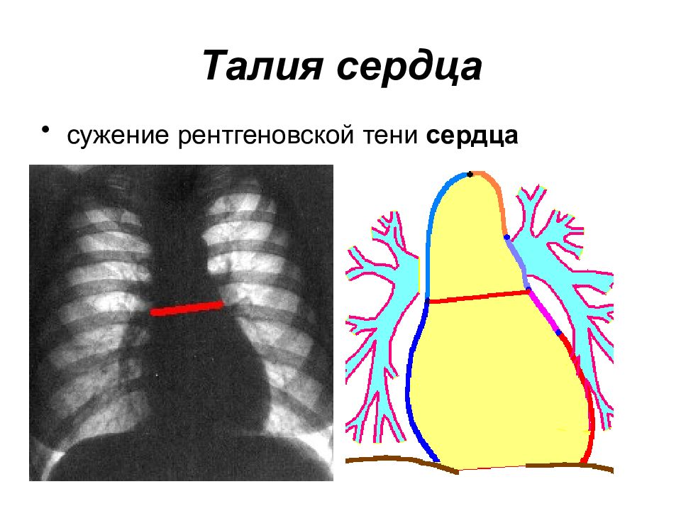 Талия сердца