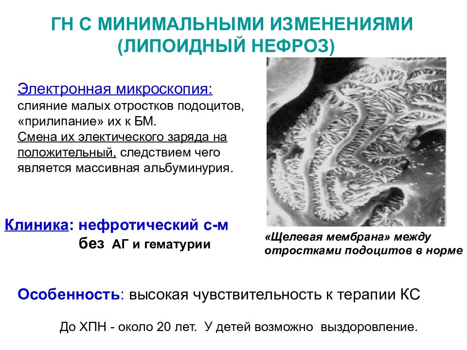 Минимальные изменения. Липоидный нефроз дифференциальная диагностика. Липоидный нефроз минимальных изменений. Болезнь минимальных изменений электронная микроскопия. Этиология липоидного нефроза.