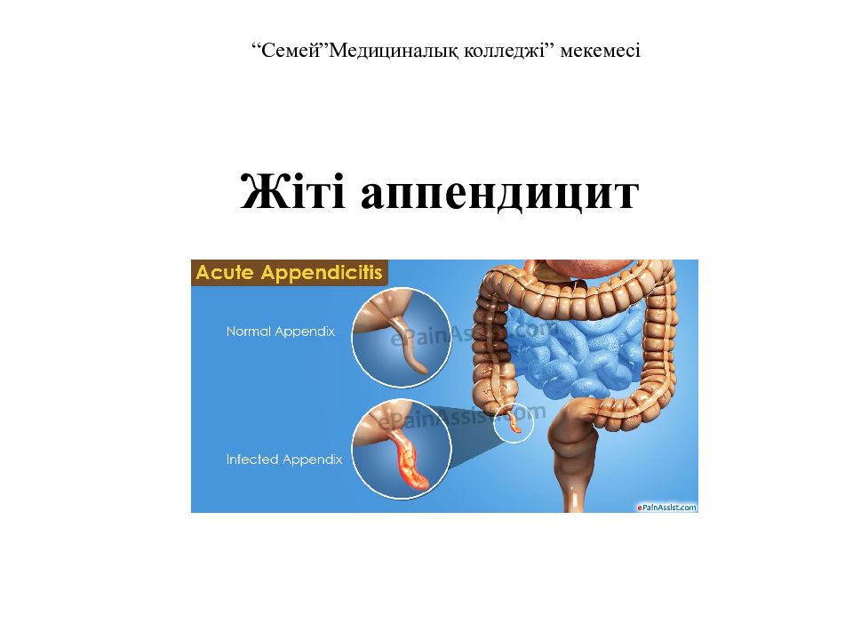 Жіті аппендицит
