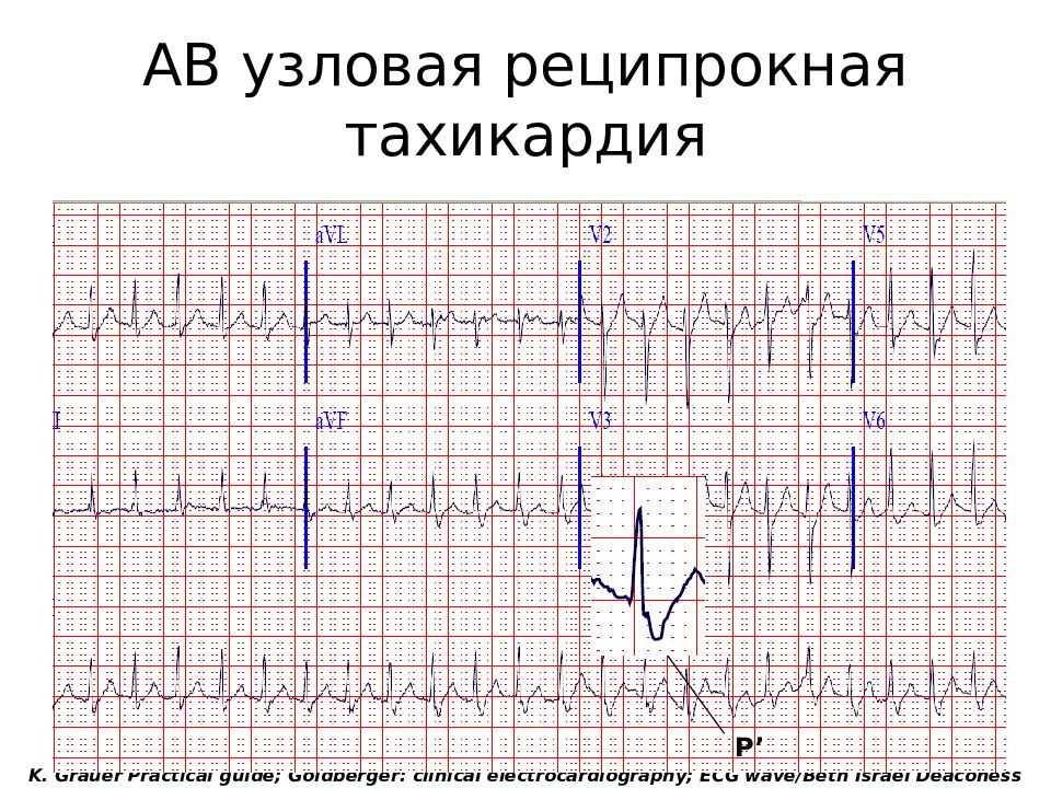 Экг картина при пароксизме суправентрикулярной тахикардии имеет вид