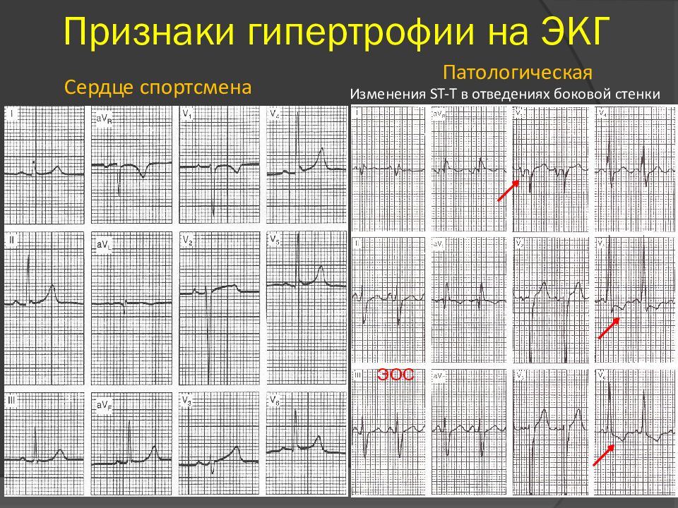 Экг спортивная