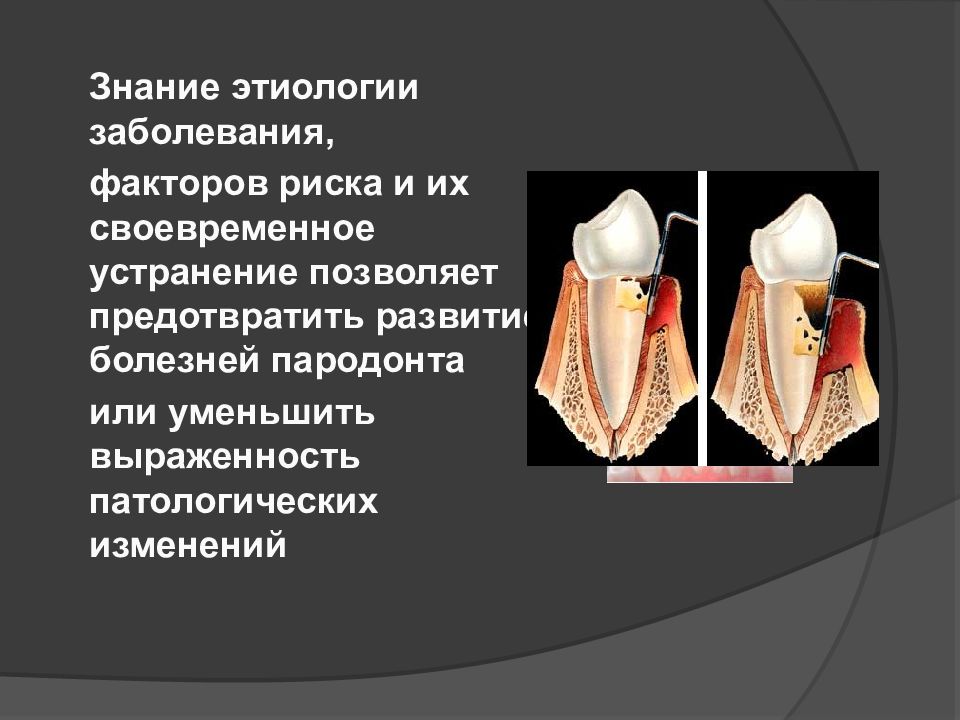 Профилактика заболеваний пародонта презентация