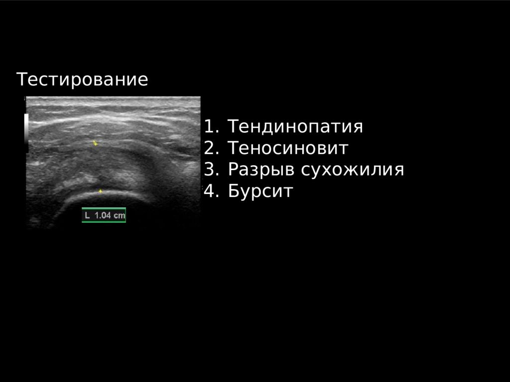 Узи плечевого. УЗИ плеча. УЗИ плечевого сплетения. Теносиновит на УЗИ. Межлестничная блокада под УЗИ.