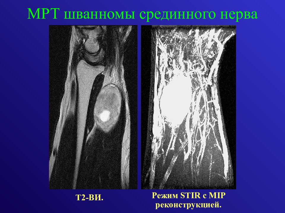 Мрт нервов. Мрт исследование периферических нервов. Шваннома срединного нерва. Шваннома малоберцового нерва.