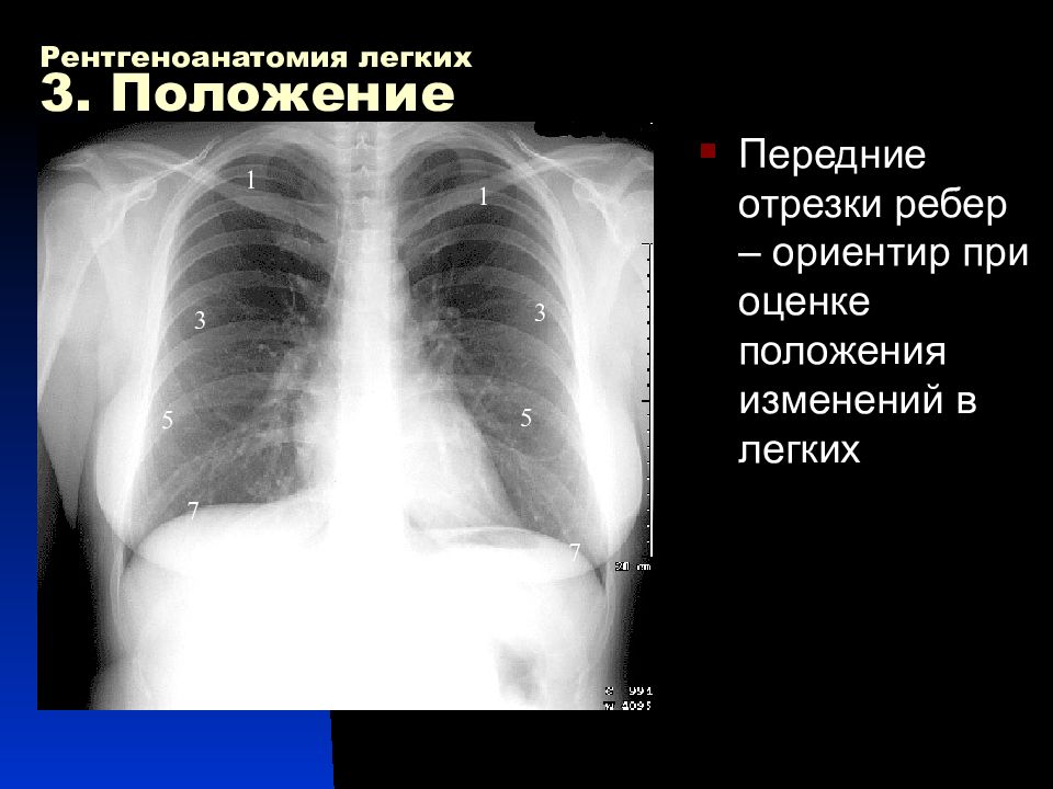 Отрезки ребер. Передние и задние отрезки ребер на рентгенограмме. Рентгеноанатомия легких. Рентгеноанатомия грудной клетки. Рентгеноанатомия ребер.