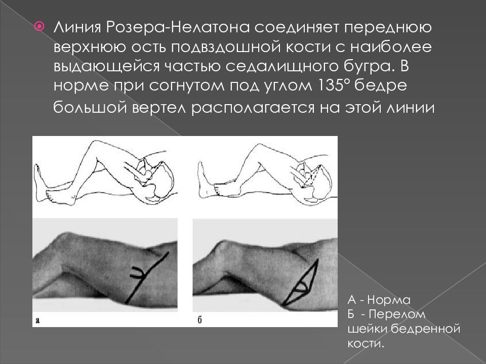 Мкб перелом бедренной. Переломы бедра презентация. Линия Розера Нелатона при переломе шейки бедра. Линия Розера Нелатона в норме.