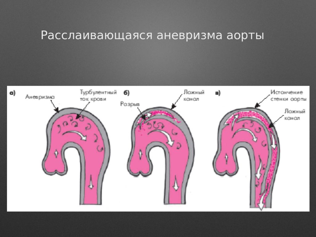 Расслаивающаяся аорта. Расслаивающая аневризма аорты патогенез. Расслаивающая аневризма аорты этиология. Патогенез расслаивающей аневризмы аорты. Этиология аневризмы аорты.