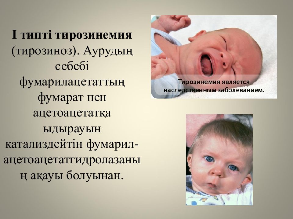 Жеке аминқышқылдардың алмасуы және оның бұзылуының биохимиялық негіздері Жеке аминқышқылдардың алмасуы және оның бұзылуының биохимиялық негіздері