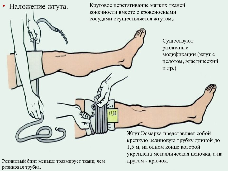 Наложение кровоостанавливающего жгута на конечности. Техника наложения жгута Эсмарха. Наложение жгута Эсмарха при кровотечении алгоритм. Техника наложения артериального жгута Эсмарха.. Техника наложения жгута Эсмарха алгоритм.