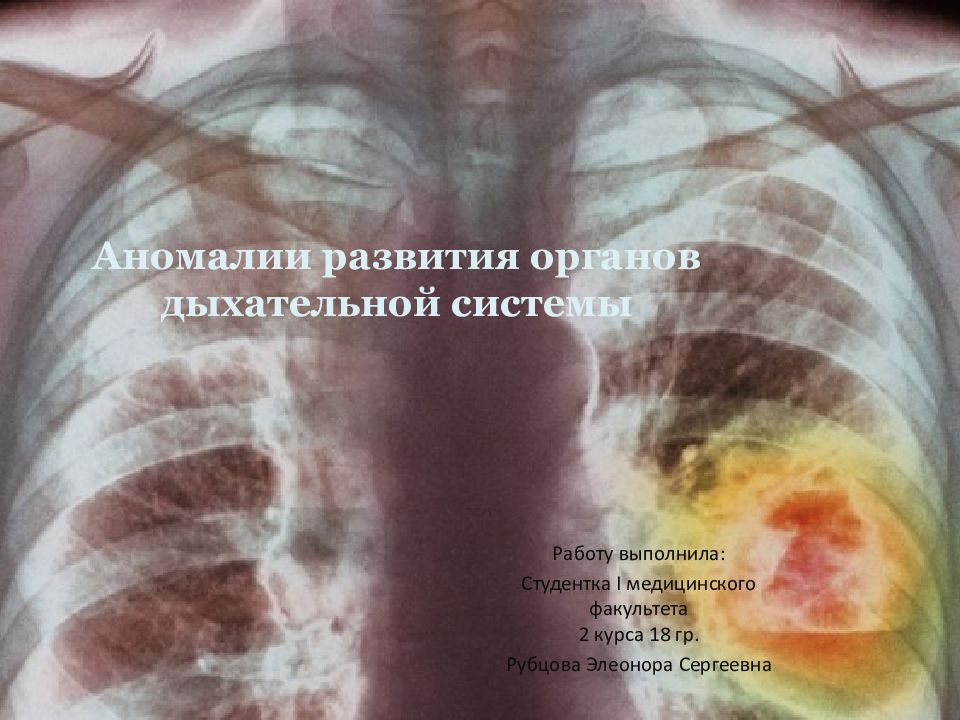 Аномалии развития органов дыхательной системы
