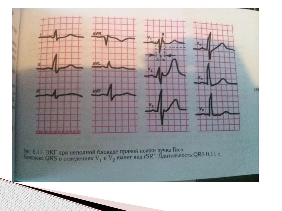 Внутрижелудочковые нарушения экг. Признаки внутрижелудочковой блокады на ЭКГ. Внутрижелудочковая блокада. Блокада левой ножки пучка Гиса.. Неспецифическая внутрижелудочковая блокада на ЭКГ. Внутрижелудочковые блокады на ЭКГ.