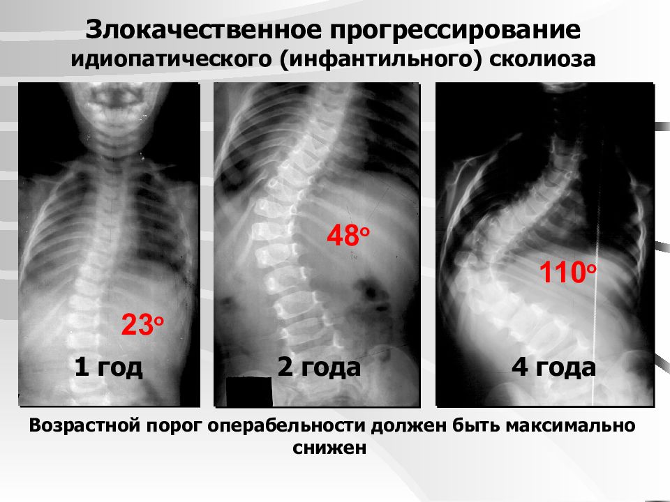 Сколиоз детская хирургия презентация