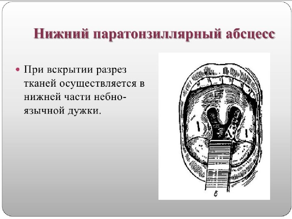 Паратонзиллярный абсцесс локальный статус карта вызова смп