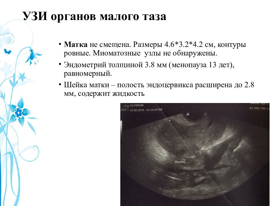 Эндометрия 3 мм. УЗИ органов малого таза матки. УЗИ органов малого таза (матка, придатки). Малый таз УЗИ.