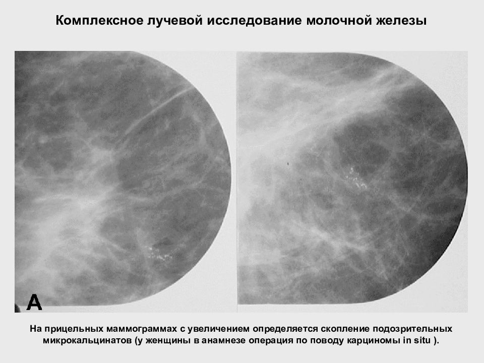 Маммография после операции. Прицельная маммография. Маммография микрокальцинаты. Прицельная маммография с увеличением. Патологии молочной железы.