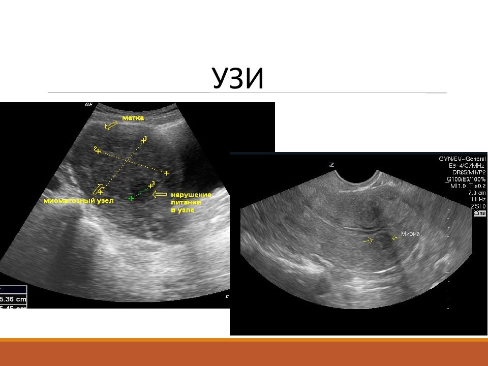Миома без узи. Миома матки презентация. Миома матки картинки для презентации.