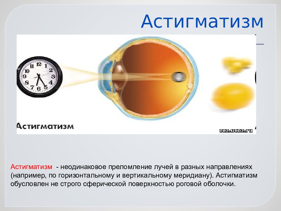 Астигматизм. Астигматизм обусловлен. Астигматизм физиология. Астигматизм презентация.