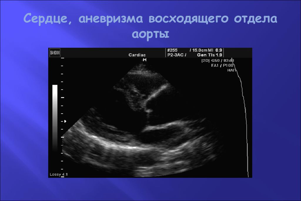 Аневризма аорты узи. Аневризма ЭХОКГ ЭХОКГ восходящего отдела аорты. Аневризма восходящего отдела сердца. Аневризма восходящей аорты.