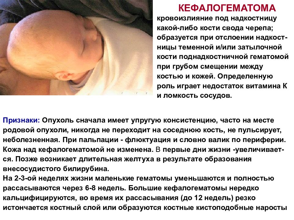 Через сколько рассосется. Кефалогематома и родовая. Родовые травмы кефалогематома.