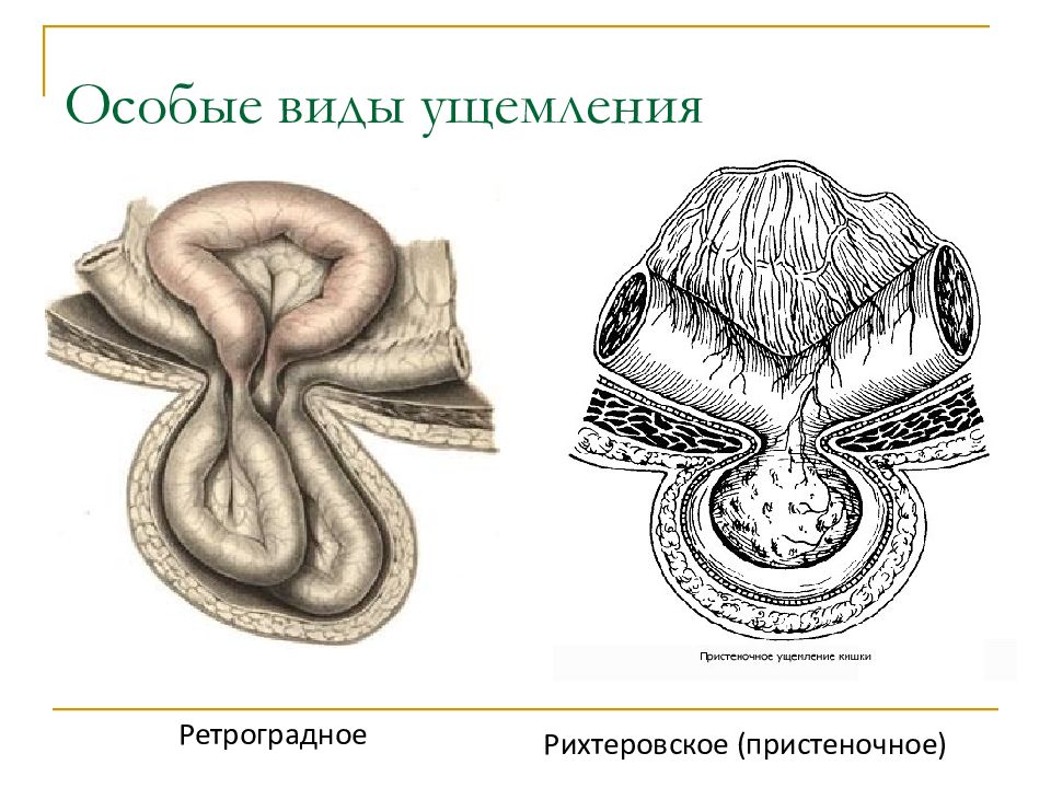 Грыжи презентация хирургические болезни