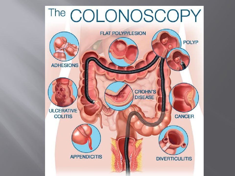 Колоноскопия аппендицит. Эндоскопическое исследование кишечника. Опухоль прямой кишки колоноскопия. Эндоскопическое исследование толстой кишки колоноскопия.