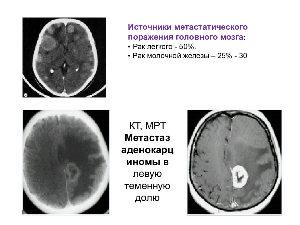 Рак головного мозга презентация