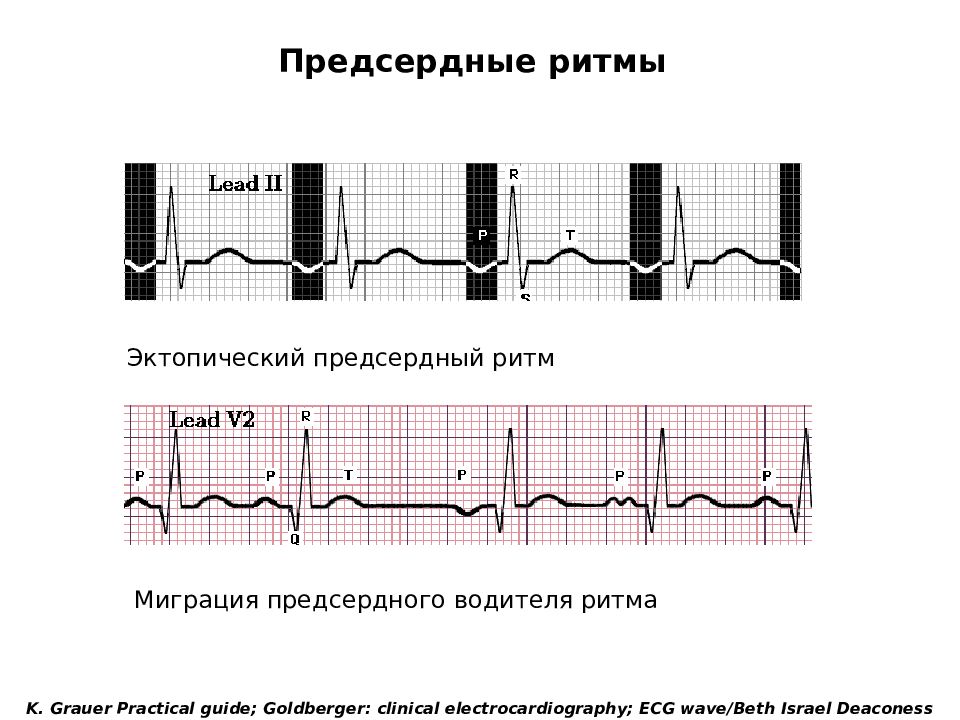 Нарушения на экг