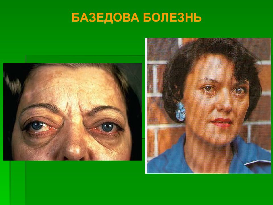 Базедова болезнь