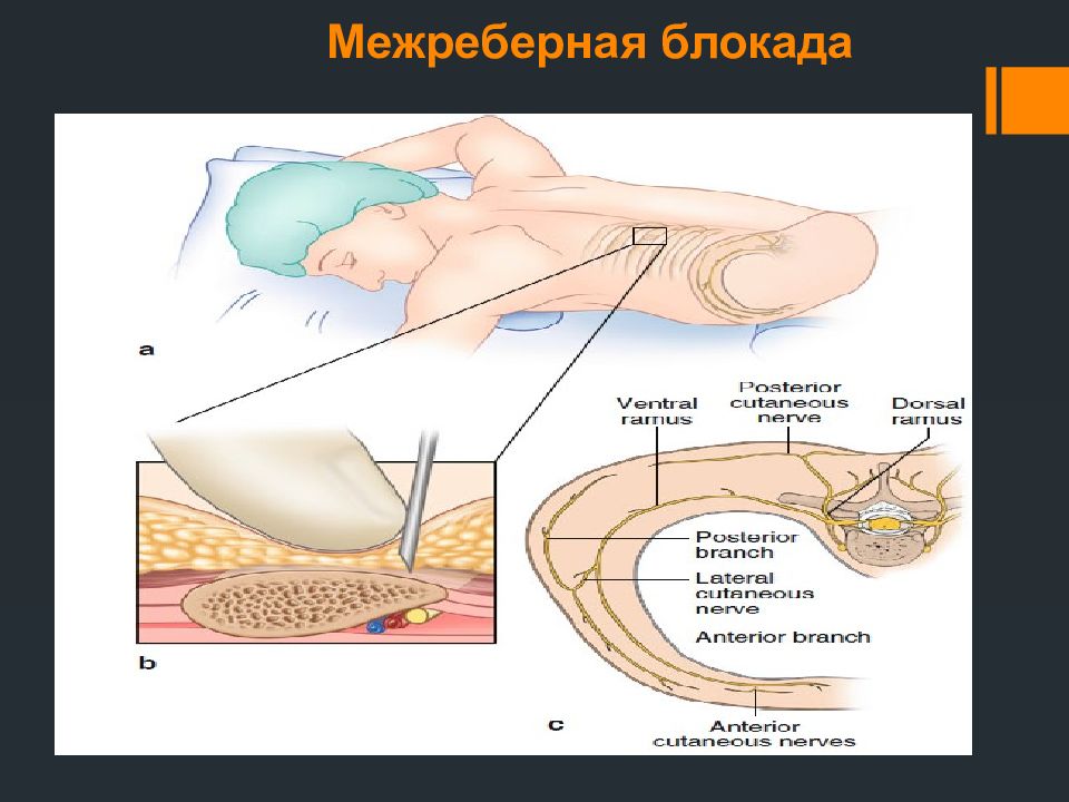 блокада при переломе ребер